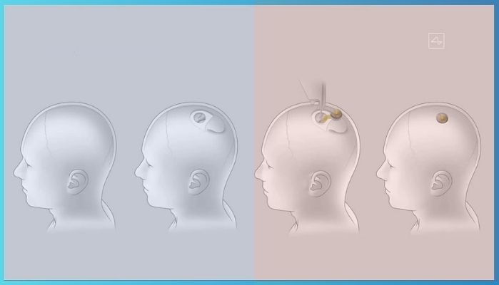 8 Key facts about Neuralink - What does Elon Musk Neuralink brain chip actually do? Neuralink Brain Chip Works